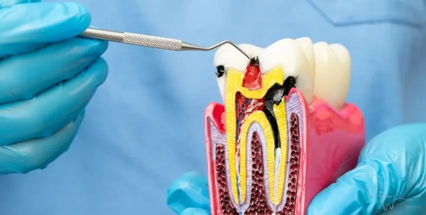 root canal therapy in longwood, fl